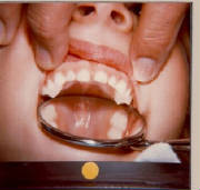 picture of PNF baby teeth from Dr. Glenn